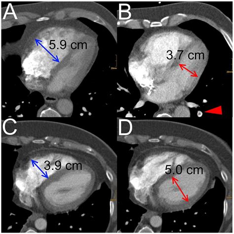 rv lv ratio pulmonary embolism